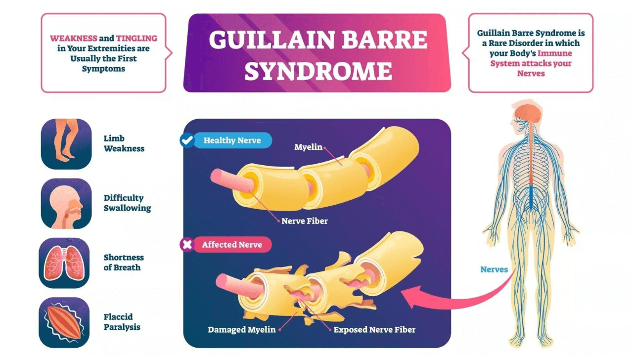 Guillain-Barre sendromu ne zaman geçer?